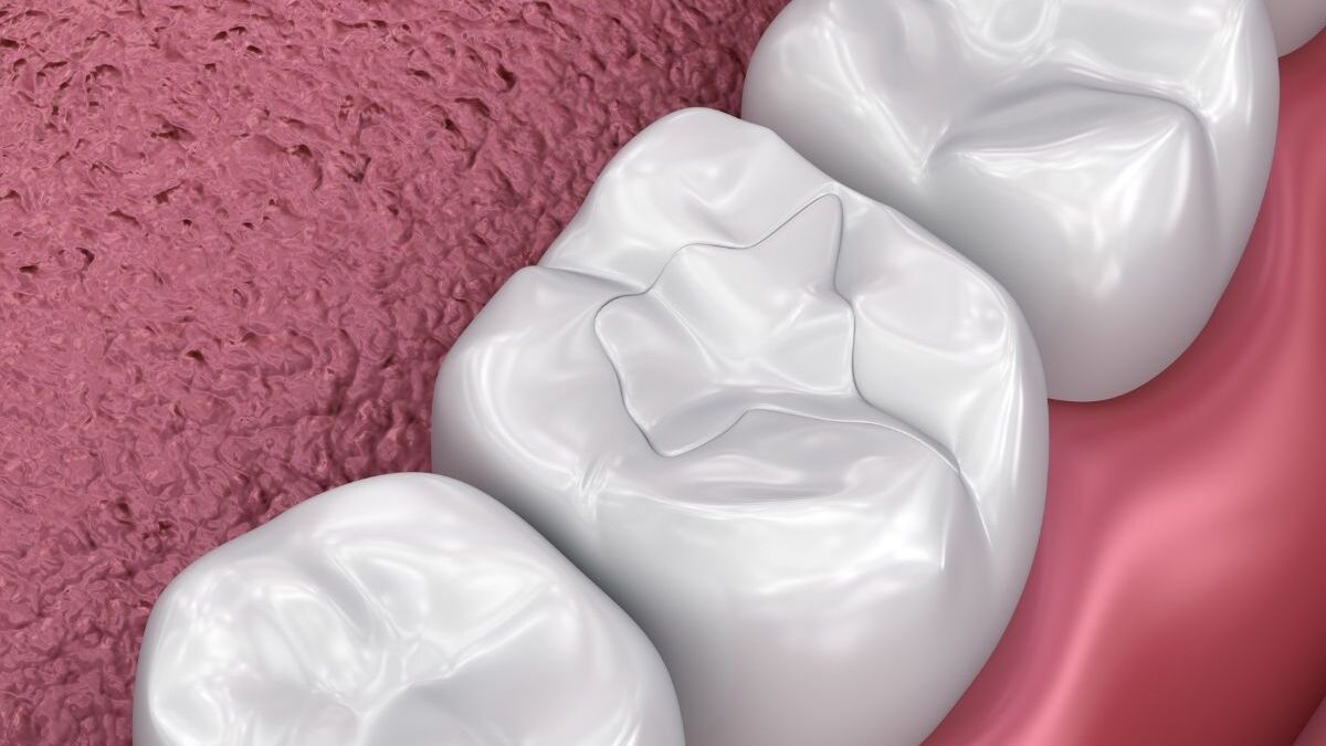 Teeth filling