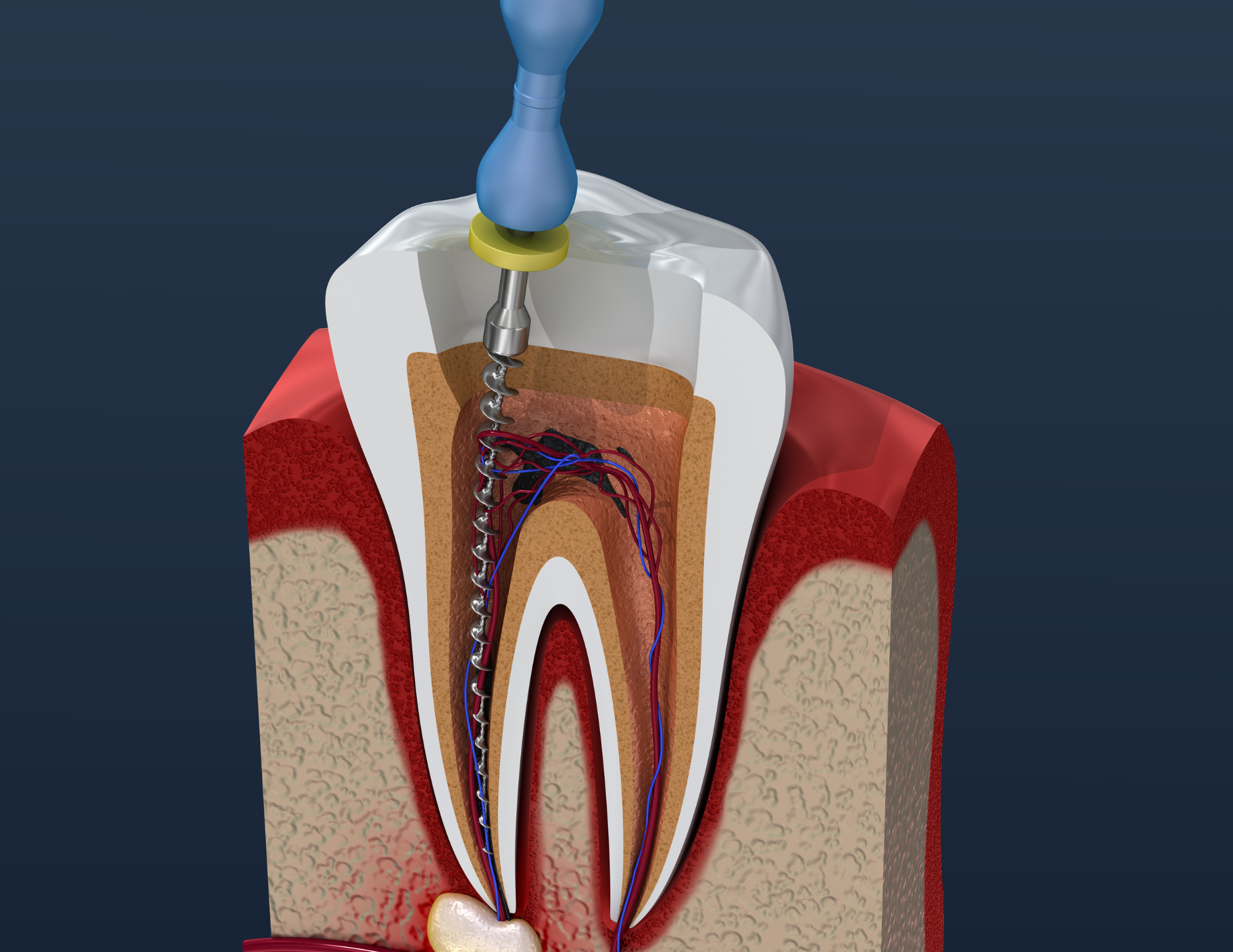 Root canal therapy
